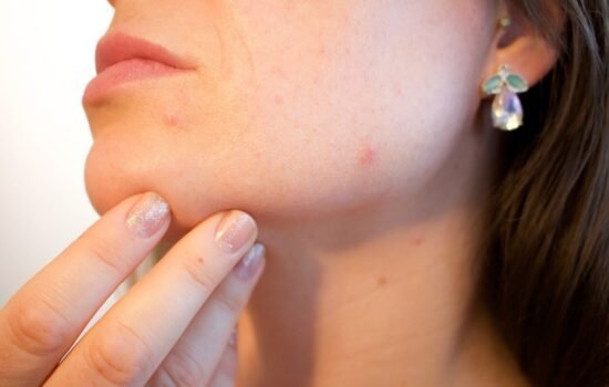 Piel con acne